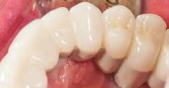 link, bredent), opaque (Gradia) and dual cement (G-CEM LinkACE, both GC Europe) bonding of zirconia crowns to framework Glass-ionomer cement cementation of the primary copings on the onepiece