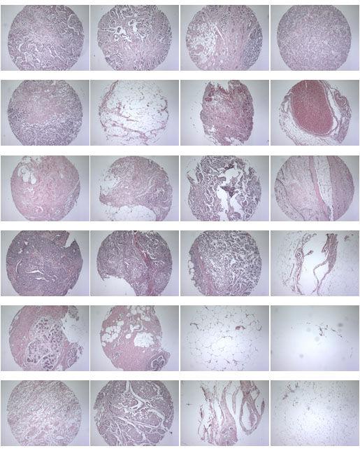 A712(19)- Test slide, Breast cancer tissues with corresponding normal tissues (formalin fixed) For research use only QC