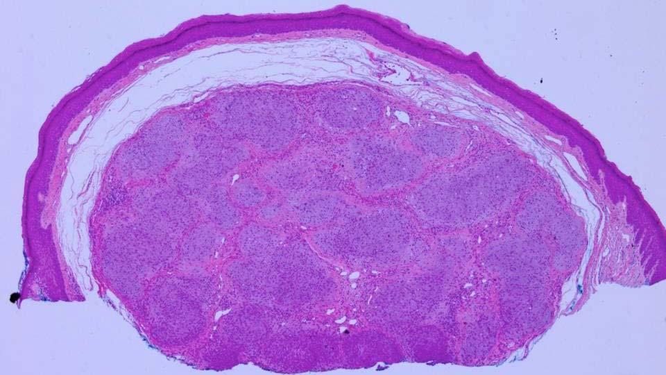 Myofibroma-like variant nests of cells fibrotic dermis