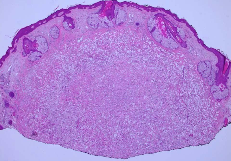 Xanthomatous Variant fibrotic dermis dome-shaped