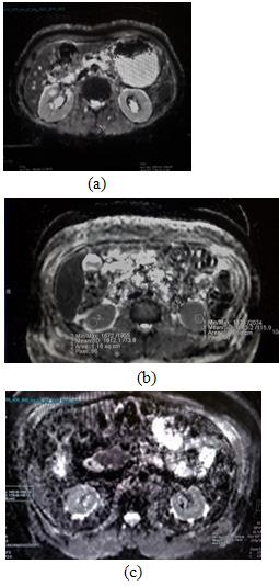 Figure 4. (a) ADC map in a 40-year-old female with normal kidney function (healthy individual), showing no restriction of diffusion, and mean ADC value was 2085 (x10-6 mm2/s).
