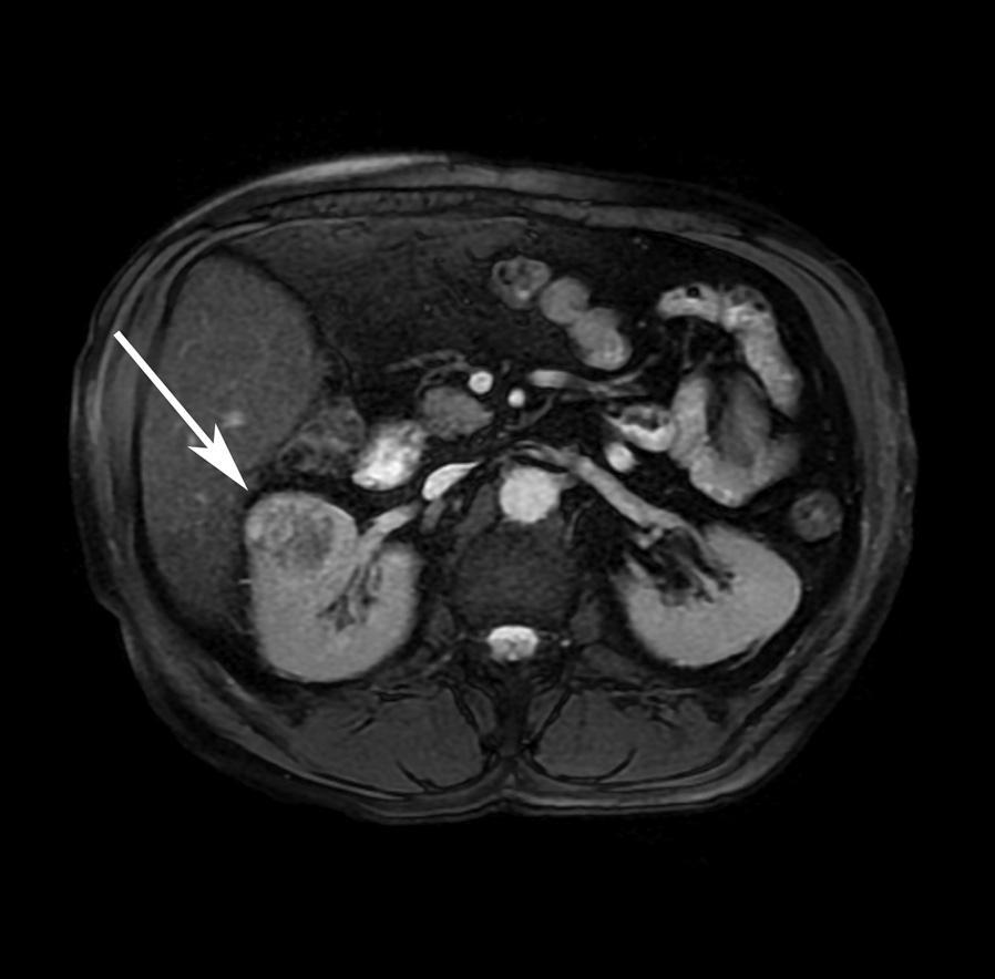 Original Article Pol J Radiol, 2014; 79: 290-295 A C B D Figure 1. Abdominal MRI of a 65-year-old man with pathologically proven clear cell renal cell carcinoma, Fuhrman grade II.