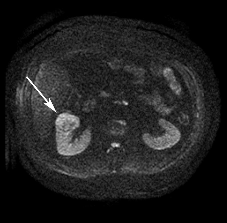 (B) On sagittal T2-weighted SSFSE, an isointense lesion of the medium renal segment with well-defined hypointense pseudocapsule (arrows) and central zone.