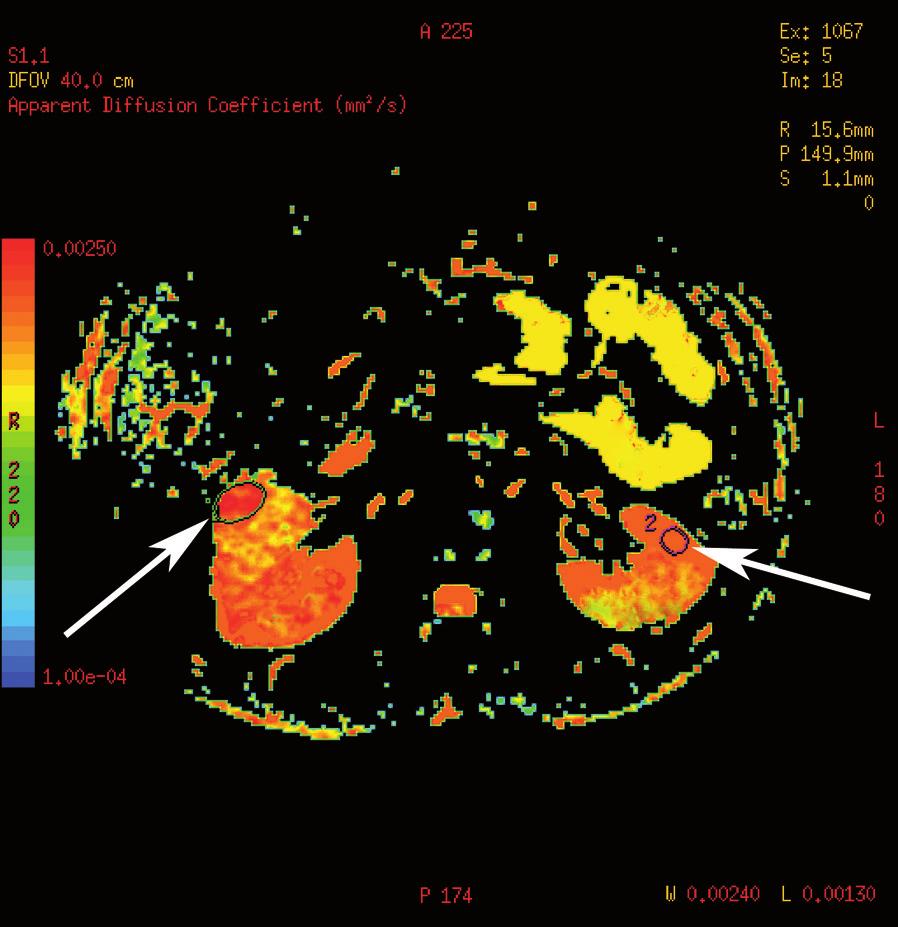 (D) ADC map with hypointense area in the right kidney (left arrow) corresponding to the hyperintese zone on DWI image, ADC=2.19 10 3 mm 2 /s.