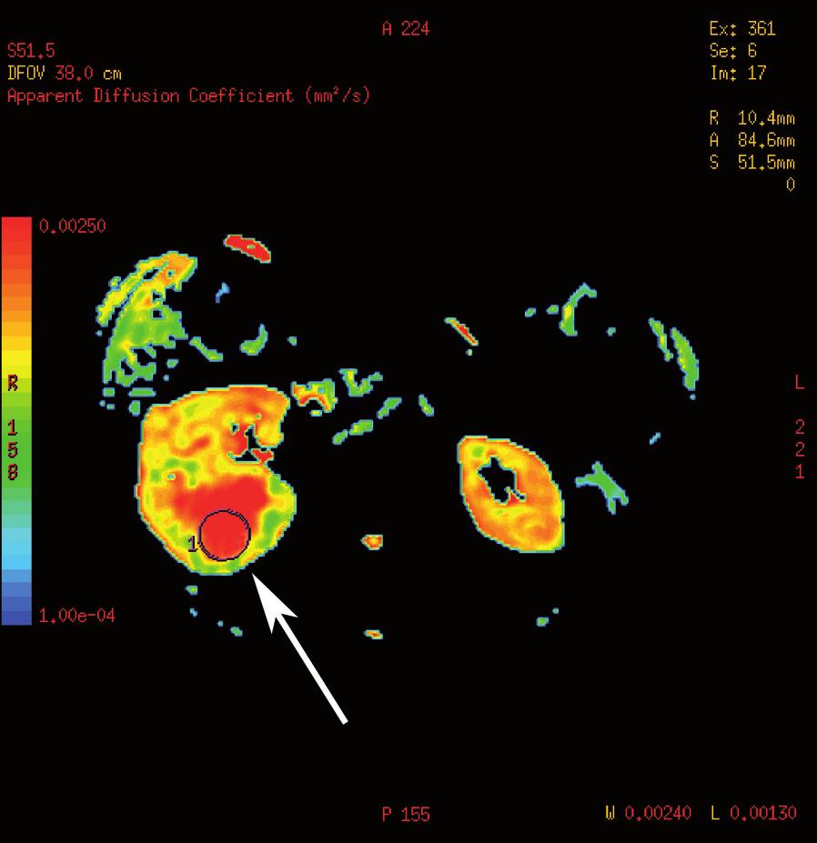 (A) Axial T2-weighted FRFSE, a large inhomogeneous lesion of the right kidney with area of hyperintensity in the posterior segment (arrow).