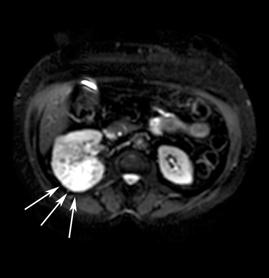 (C) ADC map with ROI over the hypointense area in the posterior segment of the right kidney (arrow) corresponding to hyperintense zone on DWI image, in that area ADC had the lowest value: 2.