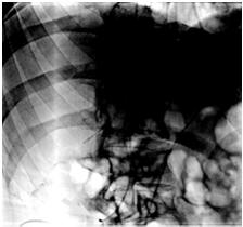Radiology Location of the catheter can be seen via a PA/lateral chest x-ray which can identify: the placement of the catheter tip trouble shooting to see if the tip