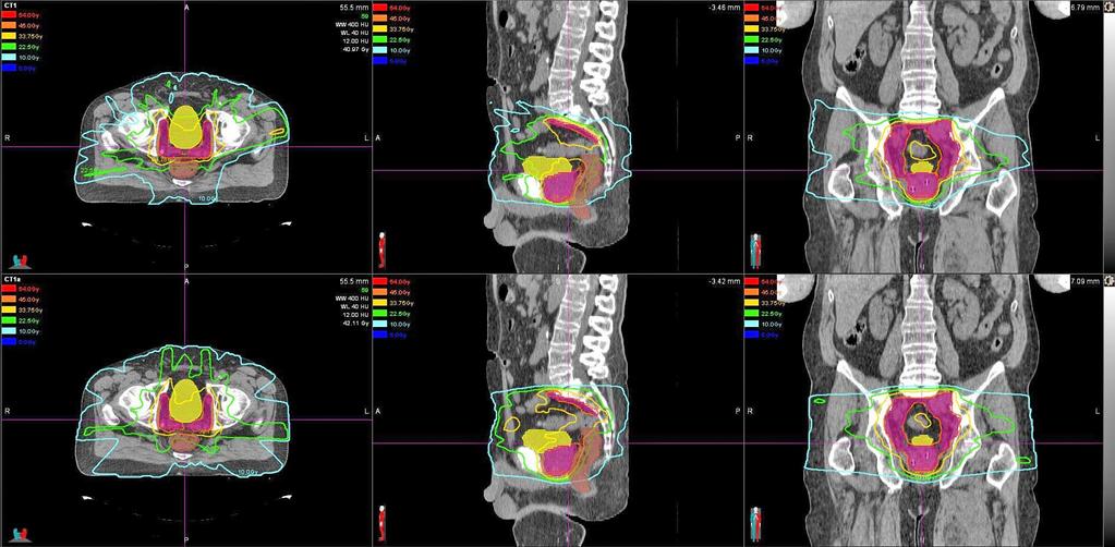 293 McGuinness et al.: RL-MLC for prostate and brain 293 Fig. 6. CT images are shown with isodose lines for Case 11.