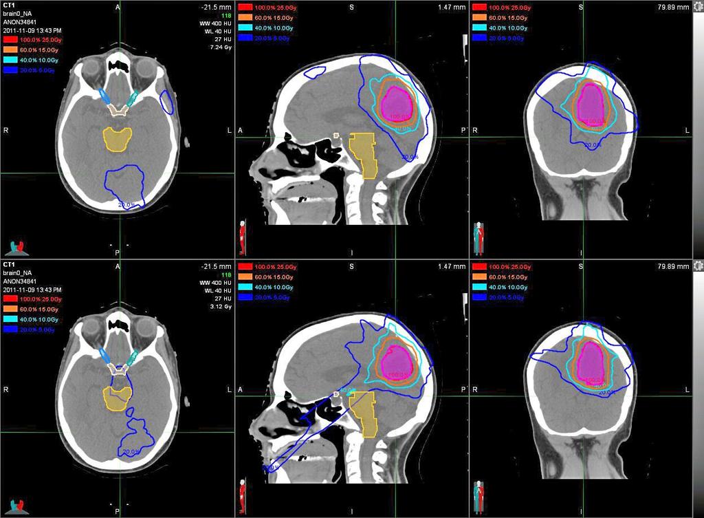 290 McGuinness et al.: RL-MLC for prostate and brain 290 Table 2. Results from five prostate (top) and five brain (bottom) SBRT cases.