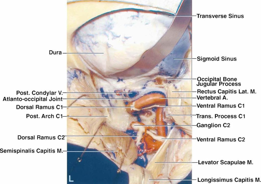 Transcondylar, supracondylar, and paracondylar approaches FIG. 2. L Q: Photographs obtained in another specimen.