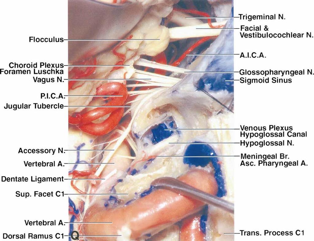 Transcondylar, supracondylar, and paracondylar approaches FIG. 2. Q: The nerves in the cerebellopontine angle have been exposed.