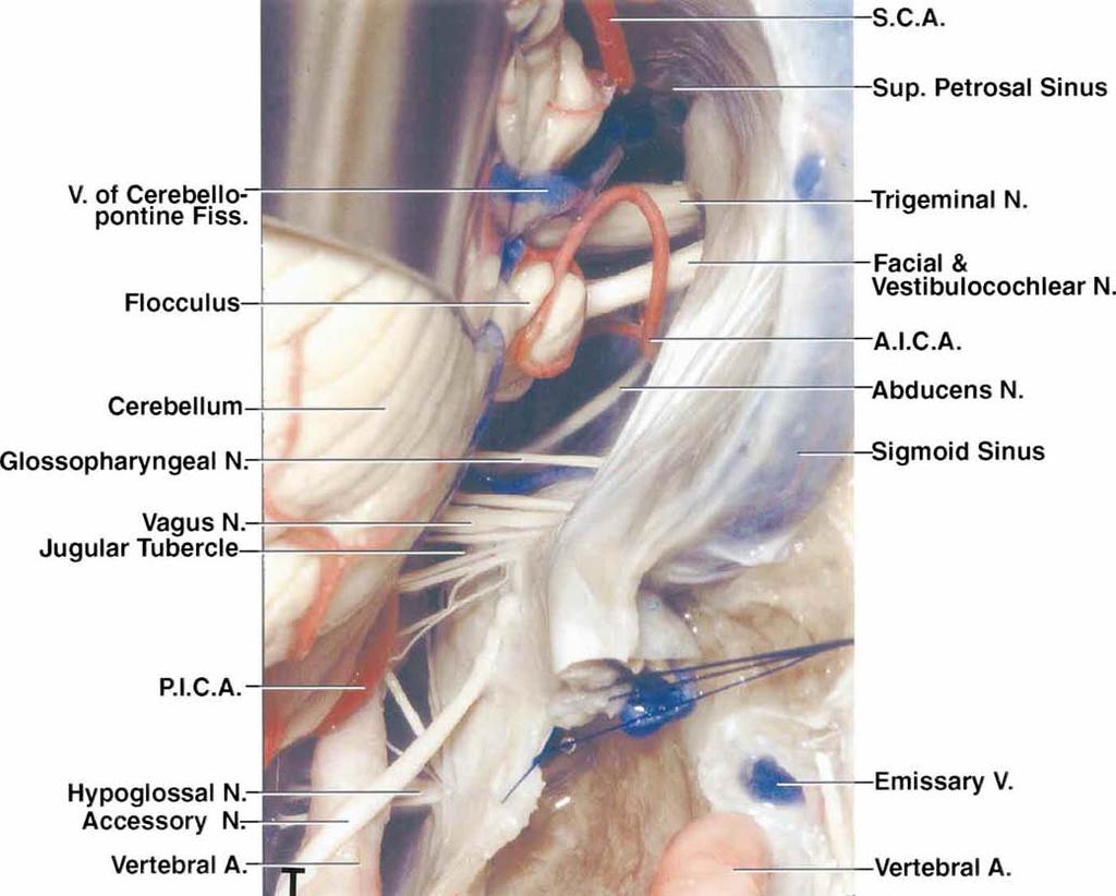 H. T. Wen, et al. FIG. 2 T: The cerebellum has been elevated to expose the facial and vestibulocochlear nerves, the flocculus, and the trigeminal and abducens nerves.