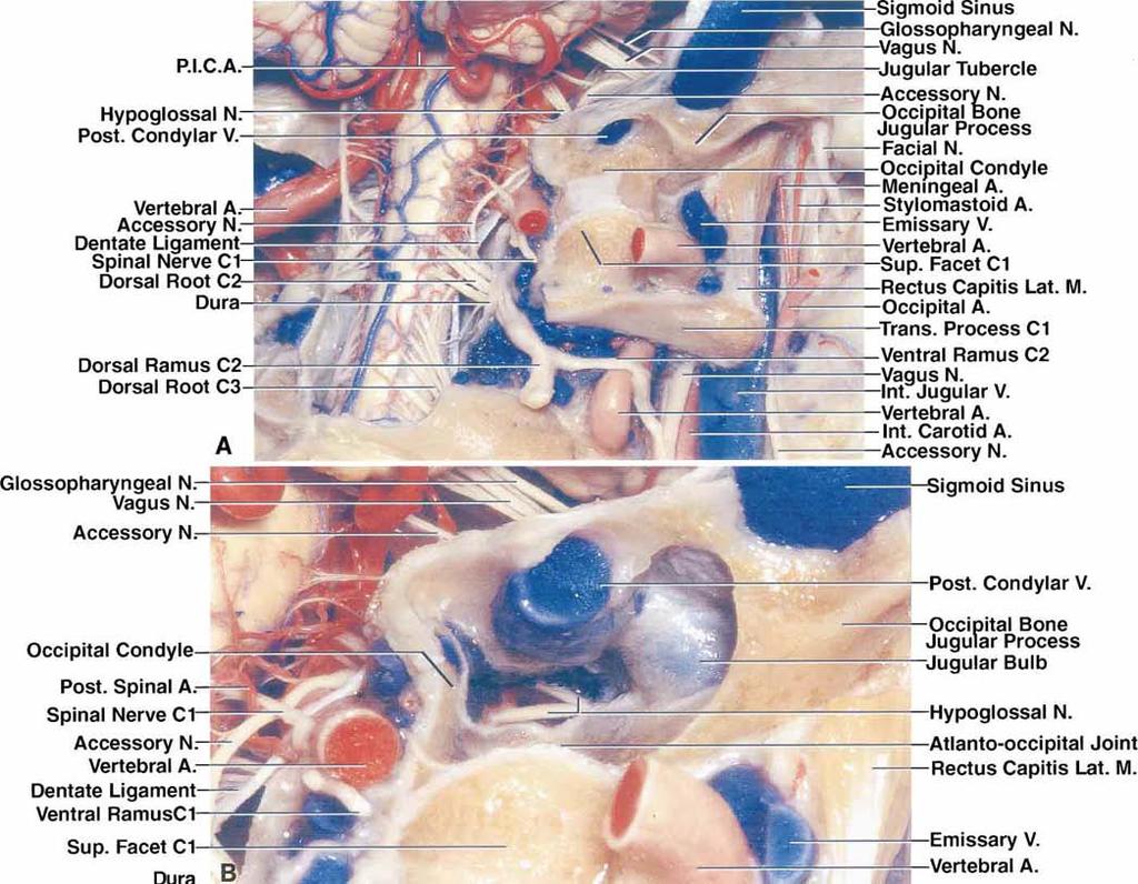 H. T. Wen, et al. FIG. 4. Photographs displaying neurovascular relationships in the transcondylar, supracondylar, or paracondylar exposures. A F: Photographs obtained from the right side.