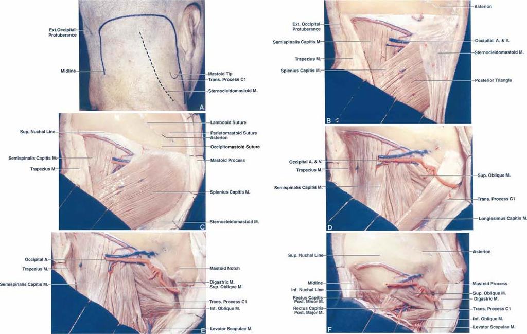 Transcondylar, supracondylar, and paracondylar approaches FIG. 2. Photographs showing muscular dissection, extradural dissection, and intradural exposure.