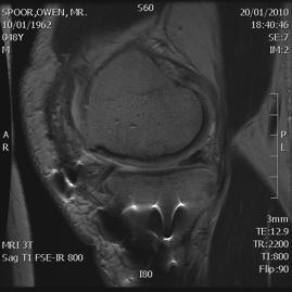 The reliability of a new scoring system for knee osteoarthritis MRI and the validity of bone marrow lesion assessment: