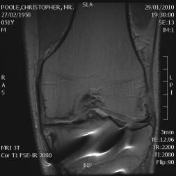 07/02/14 TKR V Uni Evaluation of articular cartilage with MRI Evaluation of articular cartilage with MRI TKR V Uni How