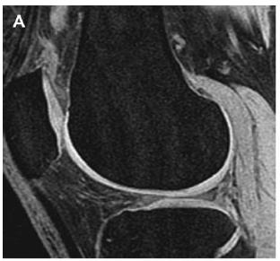 Experienced clinician better than MRI for meniscus von Engelhardt et al- less accurate for grade 3 lesions especially