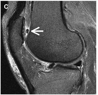 the patellofemoral compartment Osteoarthritis and Cartilage Vol.