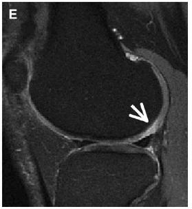 lateral femoral cartilage adjacent to the posterior horn of the