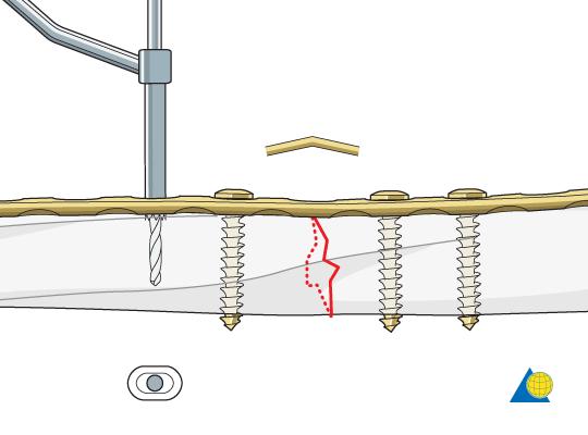 The remaining screws are then inserted. Screws closest to the fracture site are inserted first.
