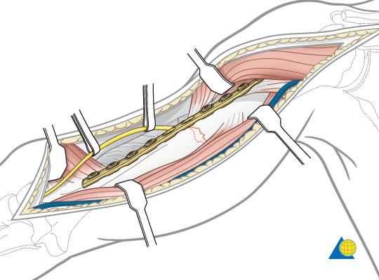 An anterolateral approach is chosen for proximal and middle third fractures, and allows supine patient positioning.