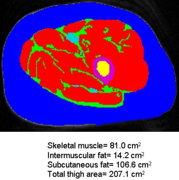 Skeletal Muscle Abnormalities in HFpEF: Lean Mass, Fat, PCr