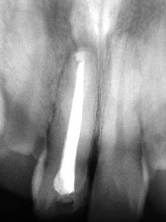 47 was endodontically treated 1 year back by a general dentist.
