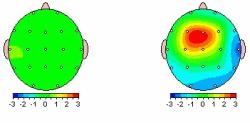 Green - Normal Red = Excessive Blue = Diminished Activity The following examples show different ways in which QEEG can