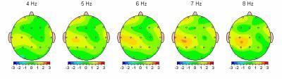 Example 1 Excessive Theta waves (4-8 Hz) at the central & left parietal area due to traumatic brain injury, presented in