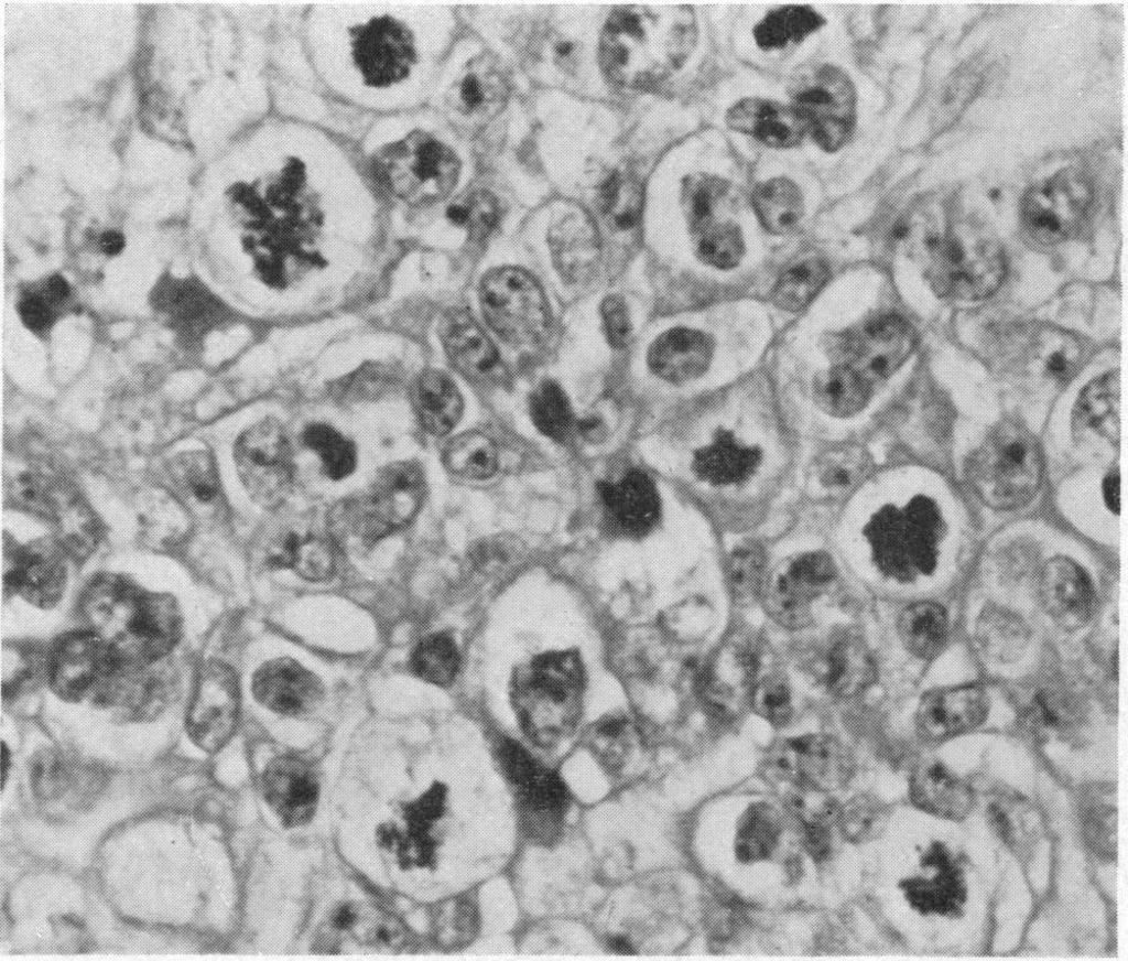 -Section from n irrdited tumour showing smll vible cells, degenertions, nd bizrre bnorml mitotic figures. (H. nd E.