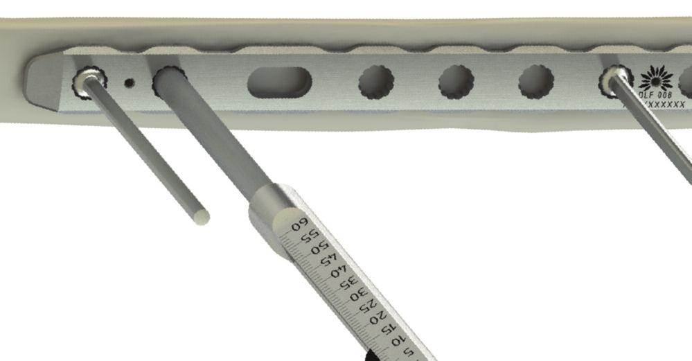 The Flower Straight Fibula Plate Surgical Strategy Step 4 Screw Measurement and Insertion a. The Depth Gauge is part of the Flower Olive Wire Kit (OWK 200) b.