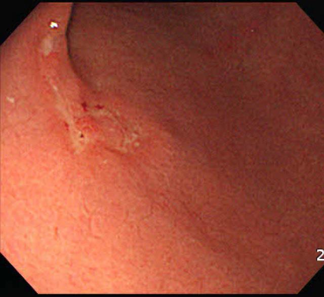 Three cases with lymph node metastasis in