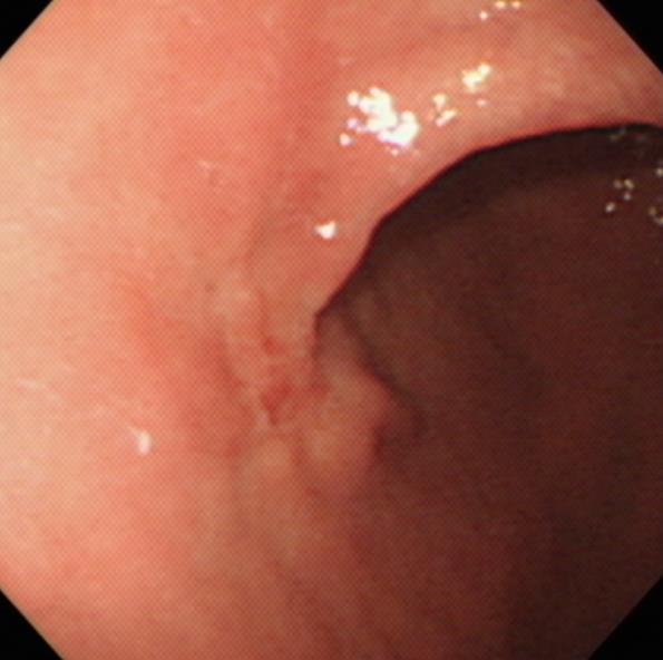 mucosal F/58 Biopsy: SRC 5 cm - mucosal