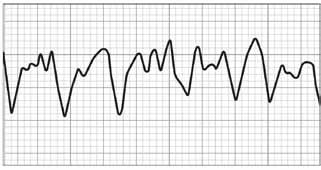 as life-threatening Shockable, or non-life threatening, Non- Shockable, based on programmed parameters. (Note Heart ECG signals contain wave-shapes that are referred to as P-QRS-T waves.