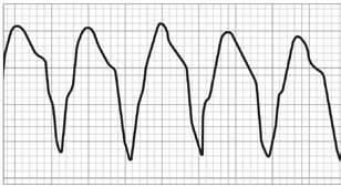Abnormally fast rhythms, in particular ventricular fibrillation is a chaotic and disorganized rhythm where these wave shapes are absent or indistinguishable.