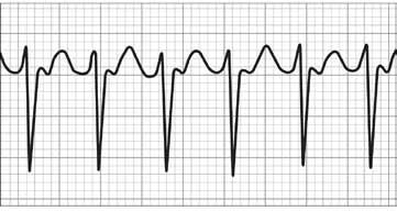 Surpraventricular Tachycardia (SVT) The AHA also recommends defibrillation therapy for supraventricular tachycardia (SVT, see figure 5).