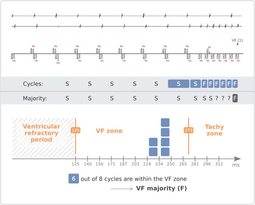 VF Majority For a given rhythm to be labelled as a VF majority rhythm, at least 6 out of the last 8 ventricular cycles must have been classified as a Fibrillation cycle.