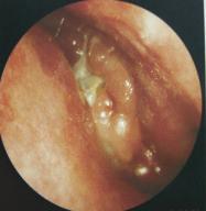 Group-3: This group comprises of small nasal polyps [figure 3 & 4] in 10 cases (8.47%).