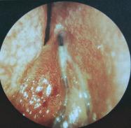 Figure-1: A septal spur protrudes to the lateral nasal wall with congested bleeding contact area.