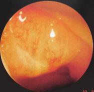 Bangladesh J Otorhinolaryngol Vol. 18, No. 1, April 2012 Figure 5: Adenoid hypertrophy Group-5: Septal ulcer in posterior part was observed in 6 cases (5.08%).