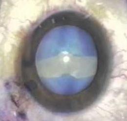 White Cataracts Pose a number of challenges during surgery Capsulorrhexis