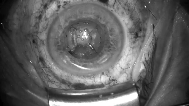 2/20/14 Michael J Taravella, MD Director: Cornea and Refractive Surgery University of Colorado 70 year old male with history of pseudoexfoliation Obvious phacodenisis on slit lamp exam Plan: