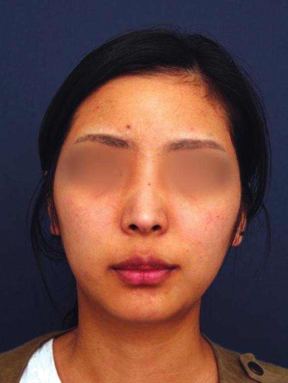 (, ) This female patient has upturned nasal tip due to scar