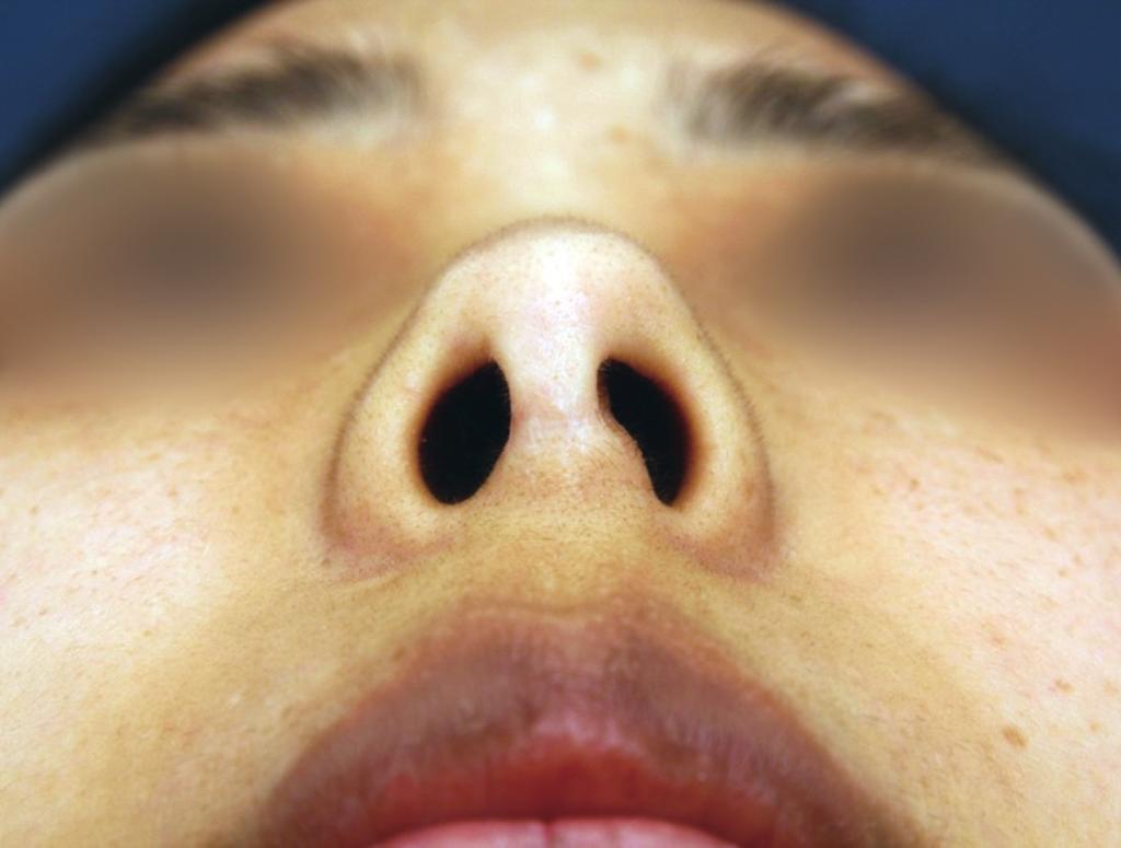 has columellar deviation and nostril asymmetry.