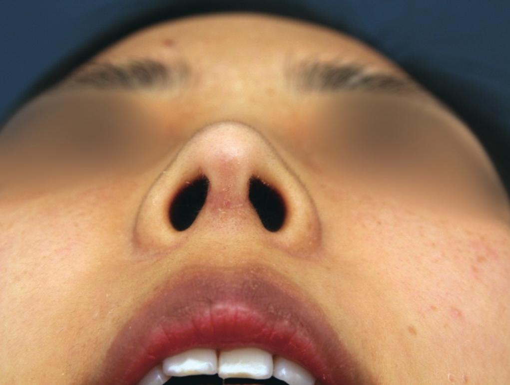 of the septum sits on the anterior nasal spine.
