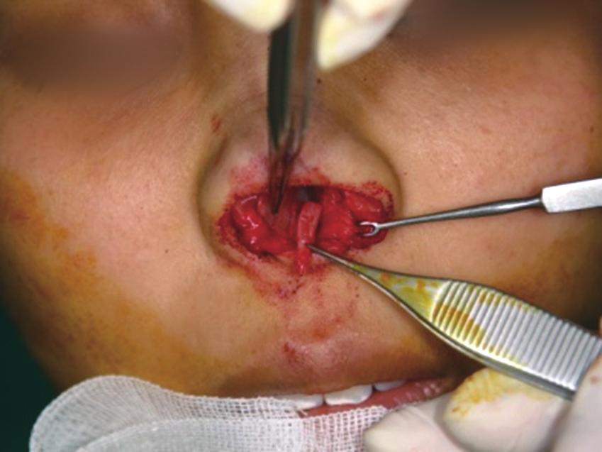 (F, G) Postoperatively, her nasal tip and columella are in the