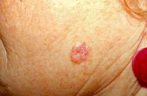 l Malignant tumors can start on the skin and