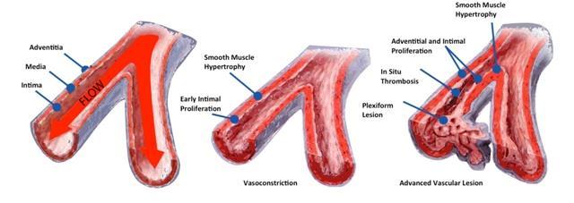 Understanding pulmonary vascular resistance. Definition: The vascular impedance that exists within the pulmonary circulation. (Mean PAP Pulm.