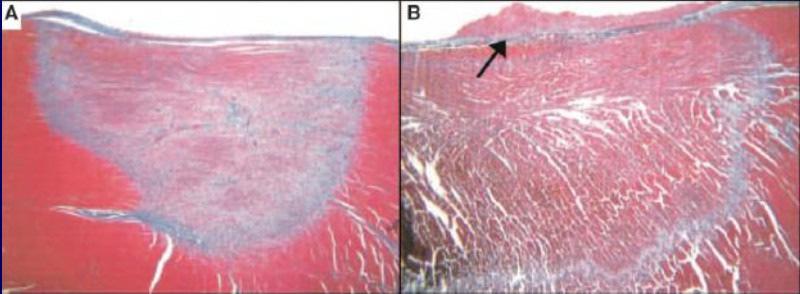 Cryothermic Lesion Characteristics Less endothelial disruption than RF, thus less thrombus formation Smaller than RF lesions Dense,