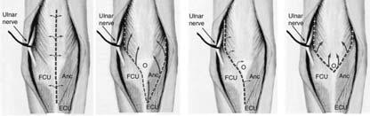 Approaches Triceps split Triceps/anconues reflecting Triceps reflecting (BM) Olecranon Osteotomy Ulnar nerve No strong evidence to support ulnar nerve transposition Some evidence to suggest increased